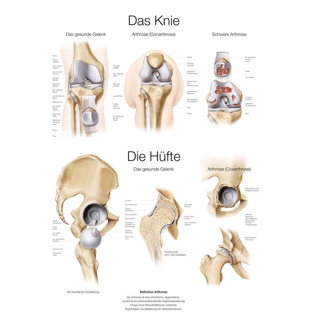 Anatomische Lehrtafel mit beschrifteten Knie- und Hüft-Schnittdarstellungen